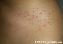 出血热皮肤病图片及症状,注意身上红疹图