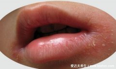初期口角炎图片及症状，嘴角起疱会糜烂结