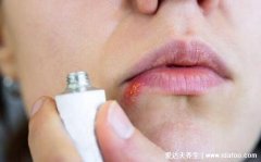 嘴唇上火起泡怎么快速消除，5个小妙招帮你