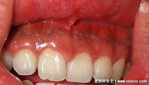 牙龈癌图片及早期三大症状,警惕溃疡和菜花样肿物的出现