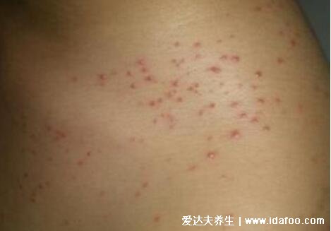 出血热症状初期照片图,发烧头疼等感冒症状需警惕(要防鼠灭鼠)