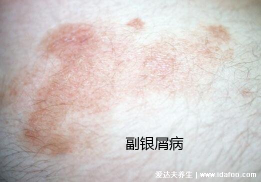 什么是副银屑病,和银屑病区别是什么(附图片)