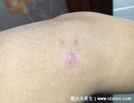 什么是副银屑病,和银屑病区别是什么(附图片)