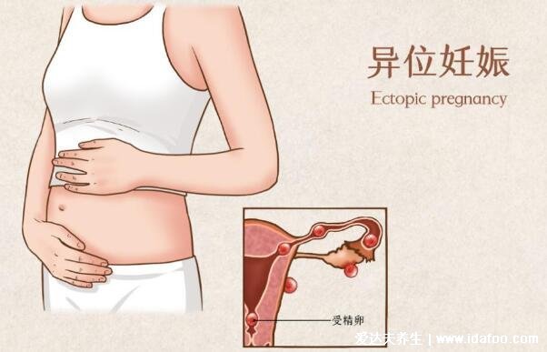 如何自我排除宫外孕,对比宫外孕早期的七个征兆自测