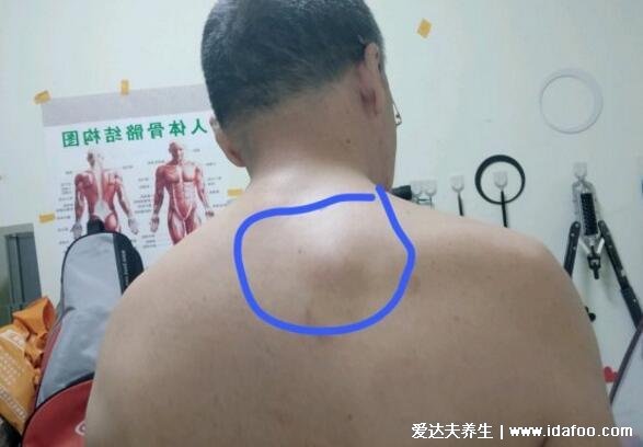 脂肪瘤图片是什么样子,背部和脖子脂肪瘤图片(40到60岁多发)