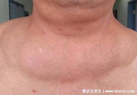 脂肪瘤图片是什么样子,背部和脖子脂肪瘤图片(40到60岁多发)