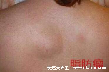 脂肪瘤图片是什么样子,背部和脖子脂肪瘤图片(40到60岁多发)