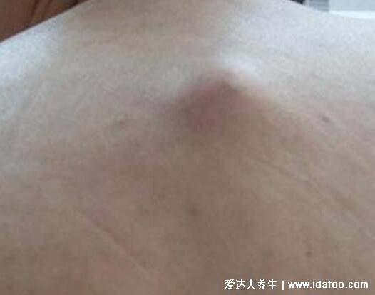脂肪瘤图片是什么样子,背部和脖子脂肪瘤图片(40到60岁多发)