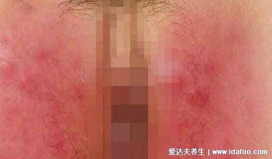 男女淋病的早期症状图片真人图,生殖器红肿有脓性分泌物