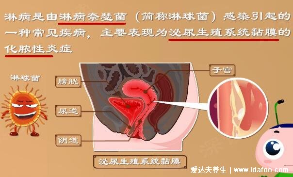 男女淋病的早期症状图片真人图,生殖器红肿有脓性分泌物