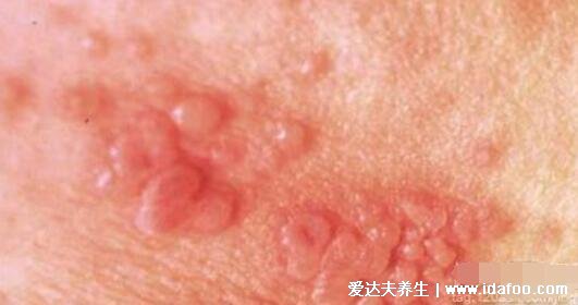 男女淋病的早期症状图片真人图,生殖器红肿有脓性分泌物
