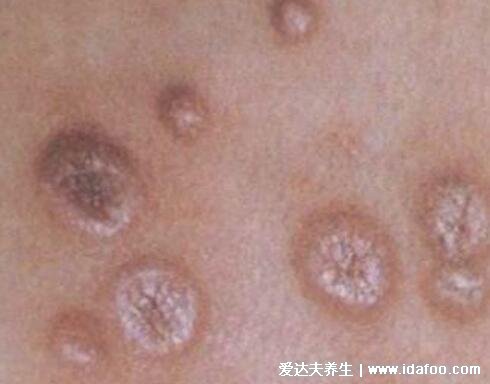 男女淋病的早期症状图片真人图,生殖器红肿有脓性分泌物
