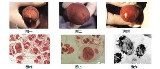 男女淋病的早期症状图片真人图,生殖器红肿有脓性分泌物