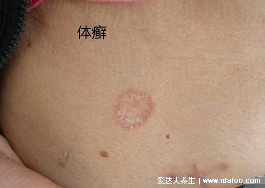 圆癣体癣钱币癣初期图片和症状,圆形红斑边缘有一圈脱屑瘙痒