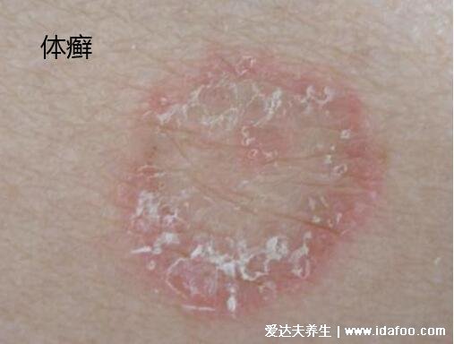 圆癣体癣钱币癣初期图片和症状,圆形红斑边缘有一圈脱屑瘙痒