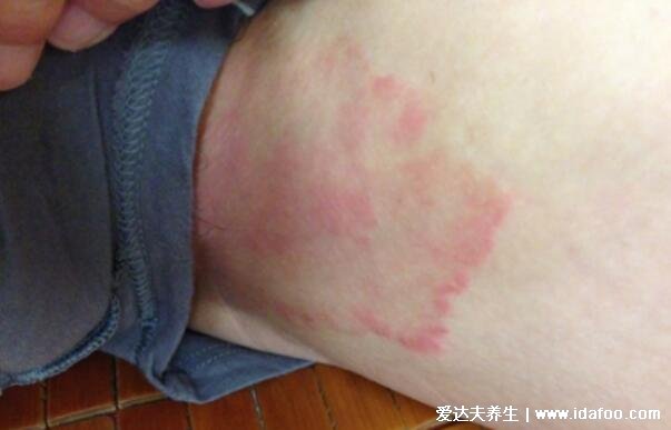 圆癣体癣钱币癣初期图片和症状,圆形红斑边缘有一圈脱屑瘙痒