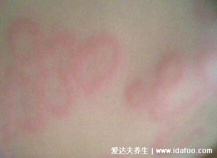 麻疹图片初期症状,红色斑疹从耳后蔓延至躯干(注意和幼儿急疹区分)