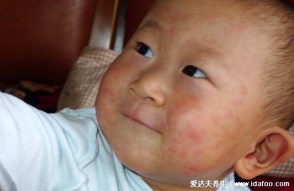 麻疹图片初期症状,红色斑疹从耳后蔓延至躯干(注意和幼儿急疹区分)