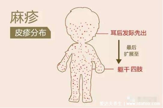 麻疹图片初期症状,红色斑疹从耳后蔓延至躯干(注意和幼儿急疹区分)