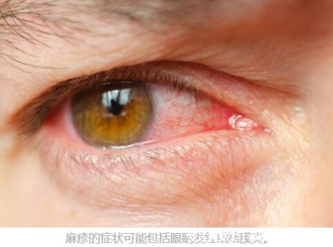 麻疹图片初期症状,红色斑疹从耳后蔓延至躯干(注意和幼儿急疹区分)