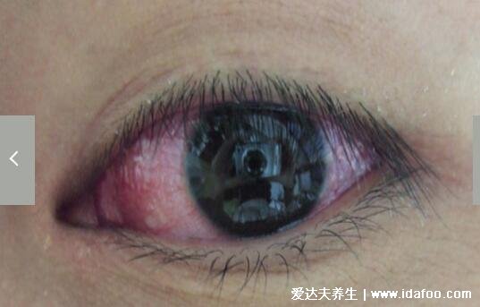 初期结膜炎图片及症状,就是红眼病有很强的传染性