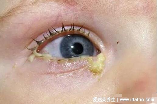 初期结膜炎图片及症状,就是红眼病有很强的传染性
