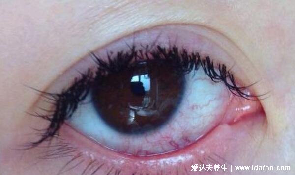 初期结膜炎图片及症状,就是红眼病有很强的传染性