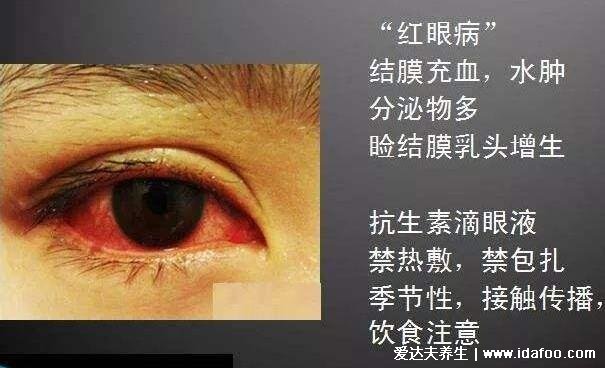 初期结膜炎图片及症状,就是红眼病有很强的传染性