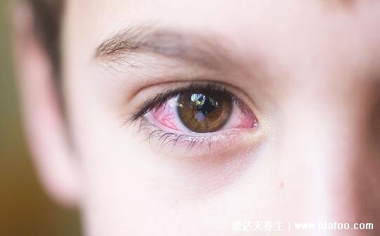 初期结膜炎图片及症状,就是红眼病有很强的传染性