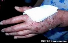 出血热症状初期照片图,发烧头疼等感冒症