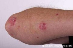 真实全身各部位鳞状细胞癌图片,警惕3大早