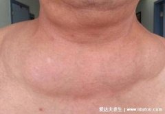 脂肪瘤图片是什么样子，背部和脖子脂肪瘤