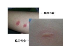 床上螨虫咬的症状图片,似蚊子包晚上比白