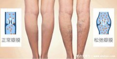 早期小腿静脉曲张图片症状，腿部疲乏无力
