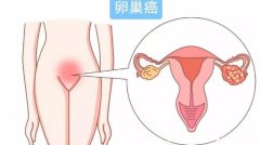 卵巢癌的症状和前兆，早期只有轻微的胃肠