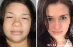 女性甲状腺的前兆图片,甲减会导致容貌异