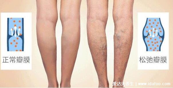 早期小腿静脉曲张图片症状,腿部疲乏无力还表浅静脉迂曲扩张