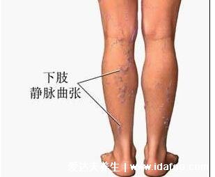 早期小腿静脉曲张图片症状,腿部疲乏无力还表浅静脉迂曲扩张