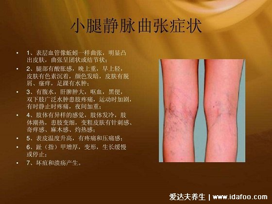 早期小腿静脉曲张图片症状,腿部疲乏无力还表浅静脉迂曲扩张