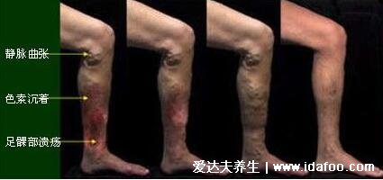 早期小腿静脉曲张图片症状,腿部疲乏无力还表浅静脉迂曲扩张