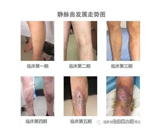 早期小腿静脉曲张图片症状,腿部疲乏无力还表浅静脉迂曲扩张