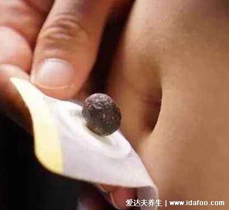 花椒贴肚脐眼正确贴法, 可搭配桂圆艾绒但易刺激皮肤(两种贴法)