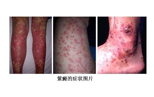 紫癜的早期症状图片,注意皮肤红点以及对称性红斑(小儿常见)
