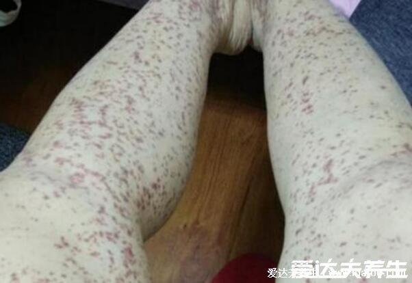 紫癜的早期症状图片,注意皮肤红点以及对称性红斑(小儿常见)