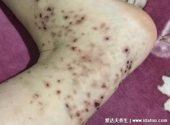 紫癜的早期症状图片,注意皮肤红点以及对称性红斑(小儿常见)