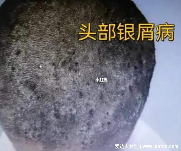 头皮上有大块头皮屑还有结痂,警惕溢脂性皮炎以及银屑病