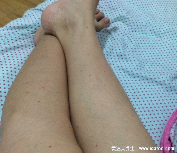 正常皮下出血点图片,注意紫癜和淤青的区别图片