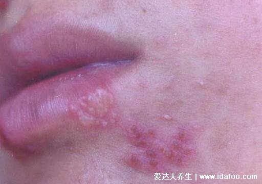 初早期女性单纯疱疹图片与症状图片，生殖器疱疹和口腔疱疹(并发症很可怕)