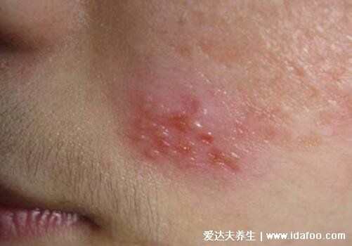 初早期女性单纯疱疹图片与症状图片，生殖器疱疹和口腔疱疹(并发症很可怕)