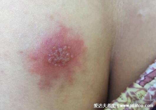 初早期女性单纯疱疹图片与症状图片，生殖器疱疹和口腔疱疹(并发症很可怕)